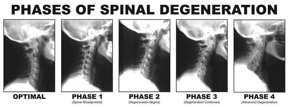 Spinal-Degeneration-Phases image Spinal Degeneration Phases